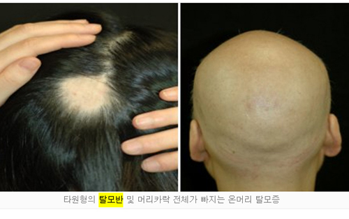 "전신탈모증 미리 예상할 수 있어"