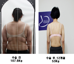 위밴드수술 환자 71%…1년 후 30Kg 감량 