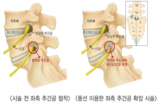 서울아산병원, '풍선확장술' 척추 협착 새치료법 개발