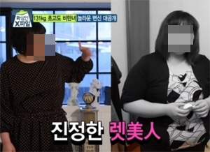 초고도비만 '화성인' 사망소식에 위밴드수술병원 당황