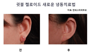"귀 뚫고 생긴 켈로이드 급속냉동으로 치료"