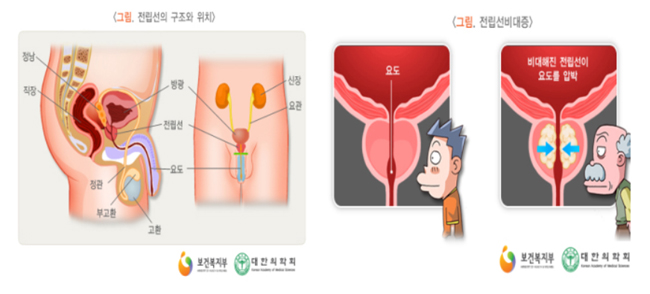 전립선비대증 10명 중 9명은 50대 이상 남성 환자