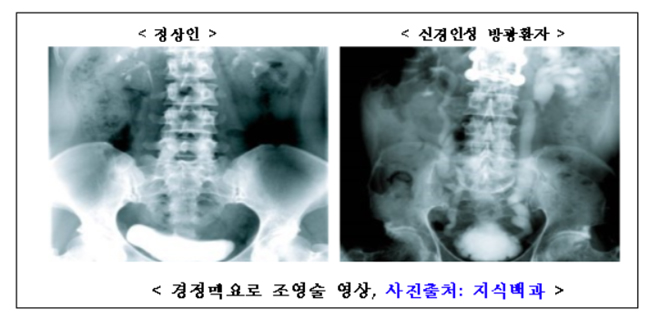 소변 잘못 보는 '신경인성 방광' 5년간 51.8% 증가