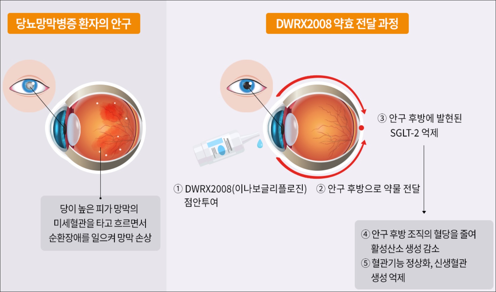 대웅그룹, 세계 첫 당뇨망막병증 점안제 개발 착수