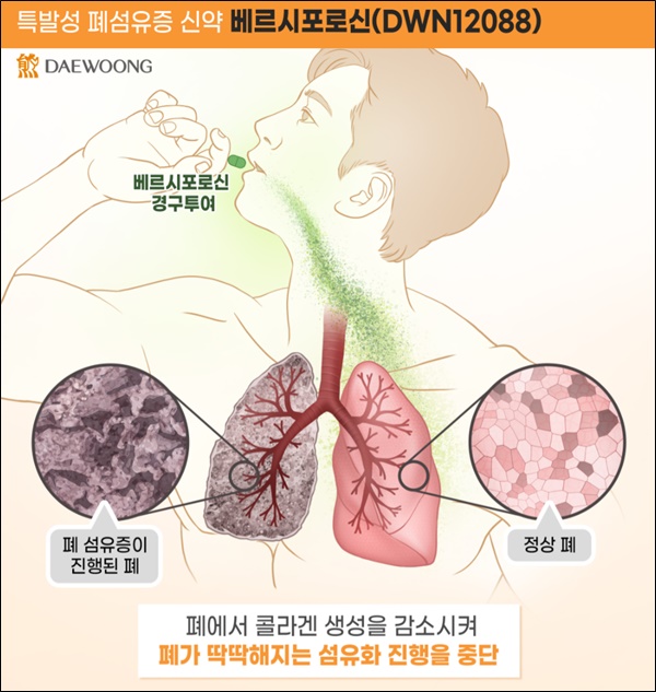 대웅제약 베르시포로신 유럽 '희귀의약품' 지정