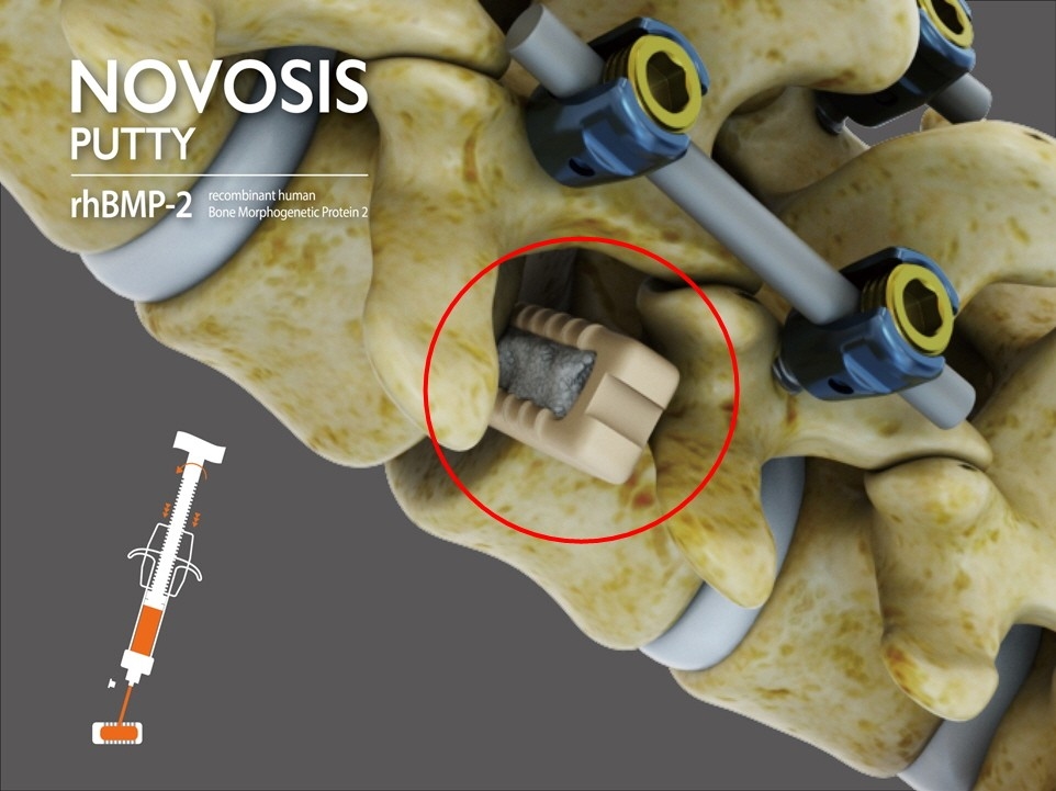 시지바이오 '노보시스 퍼티', 미 FDA 확증임상 승인