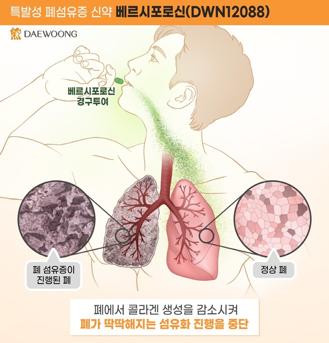 대웅제약, 글로벌 첫 '폐섬유증 신약' 개발 순항